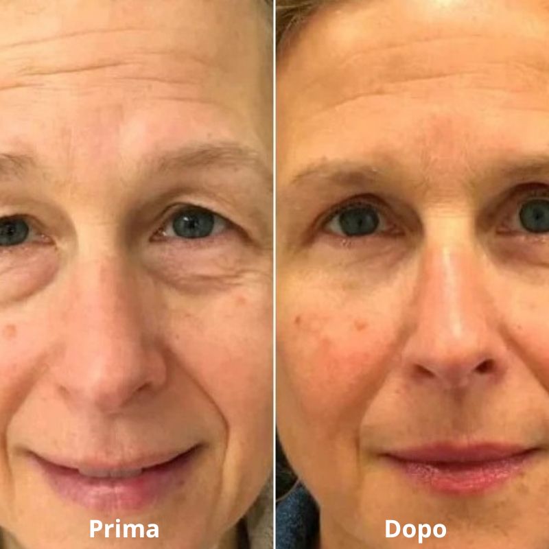 LUMILIFT® Innovazione contro borse e occhiaie